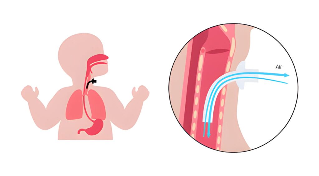 Healing the Connection A Specialist Guide to Esophageal Atresia Surgery and Recovery