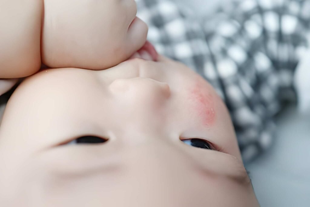Newborn Skin Rashes Distinguishing Allergic Reactions from Common Irritations