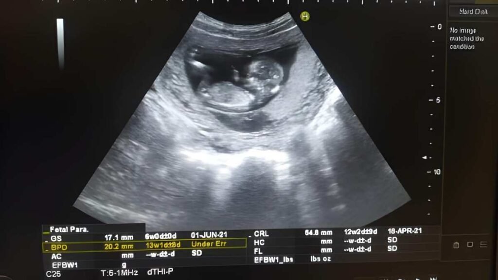 The 5.5 Week Scan Confirming Viability and Early Structure