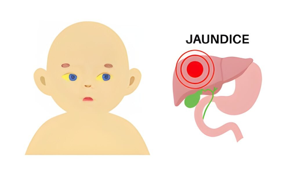 Understanding Physiologic Jaundice The Common Golden Glow