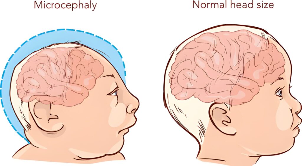 Understanding Severe Microcephaly Clinical Implications of a 14 cm Head Circumference